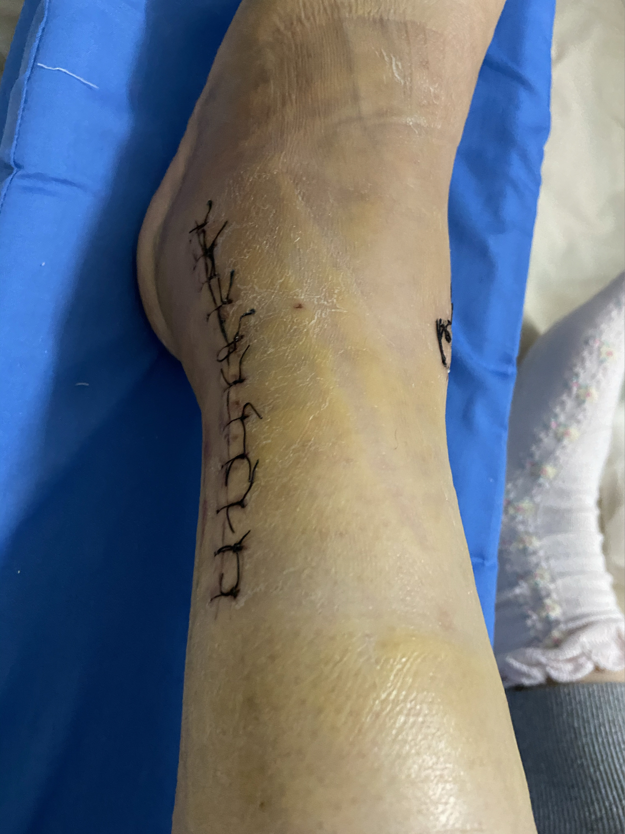 脚踝骨折之换药拆线篇