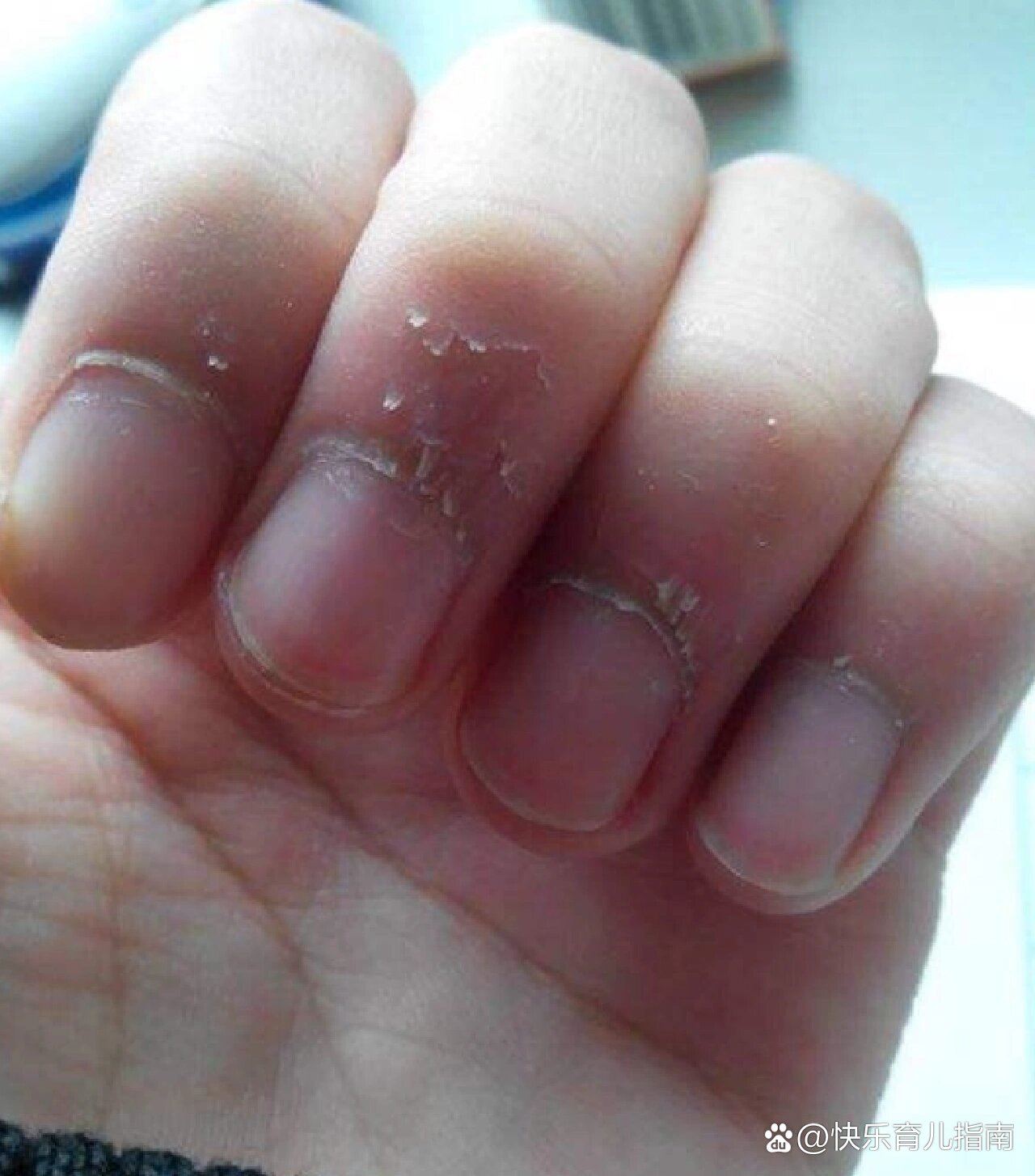 宝宝手上总有倒刺是什么原因?