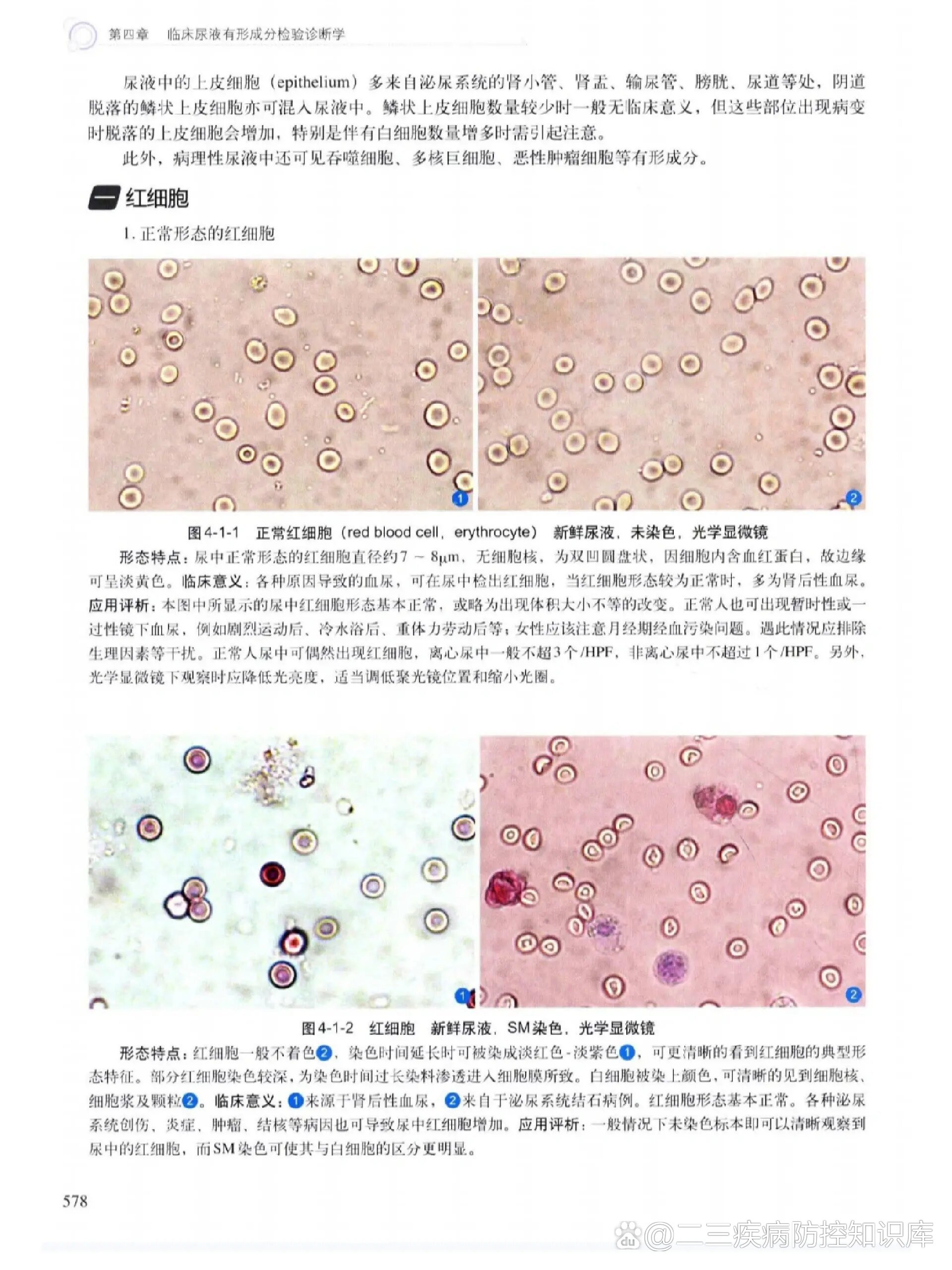 尿液中正常和异常红细胞形态分享!