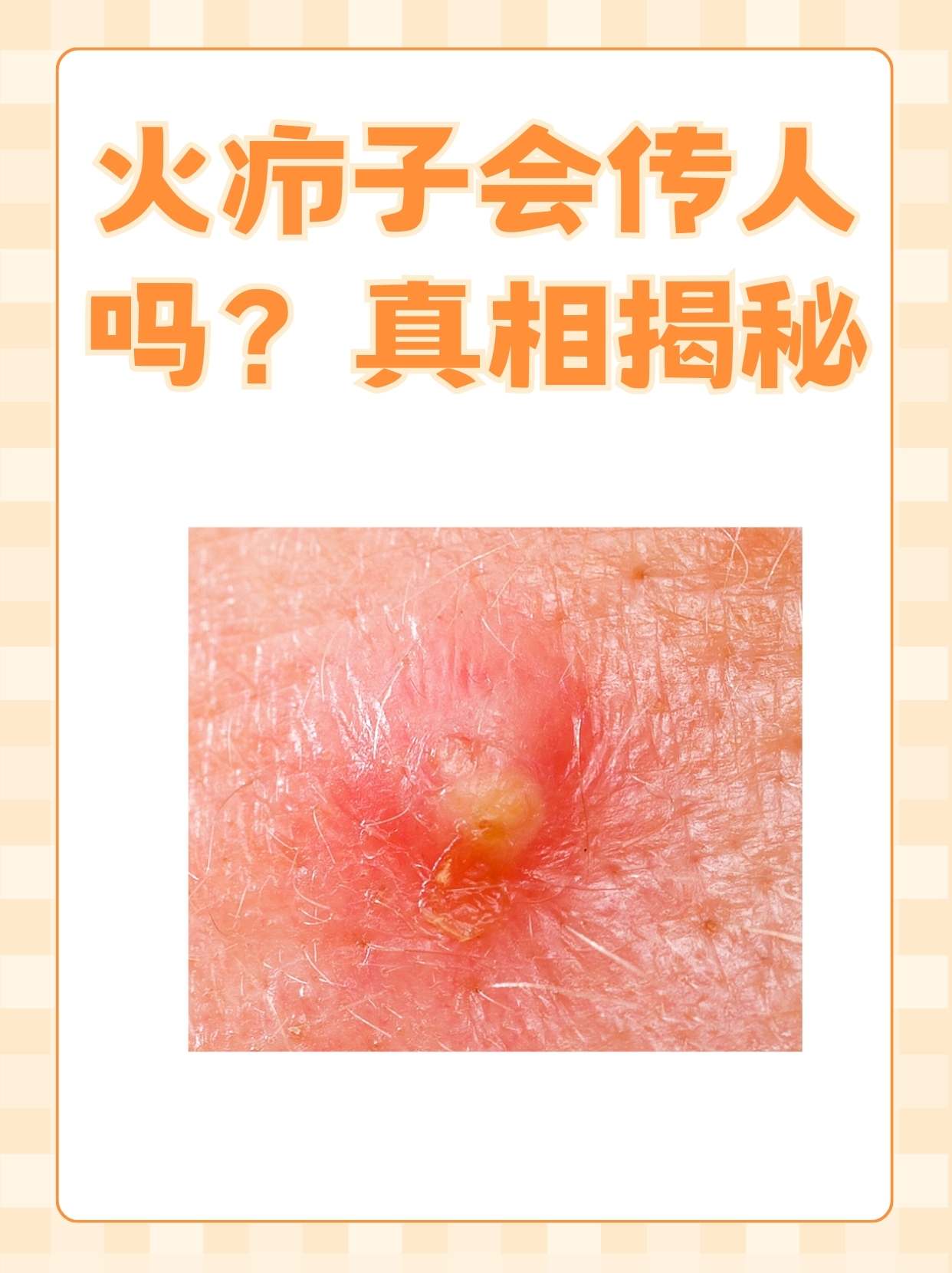 因为长时间坐在闷热潮湿的环境中,背部出现了几个火疖子前来就诊