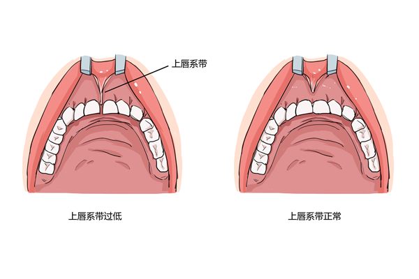 如何判断上唇系带过低