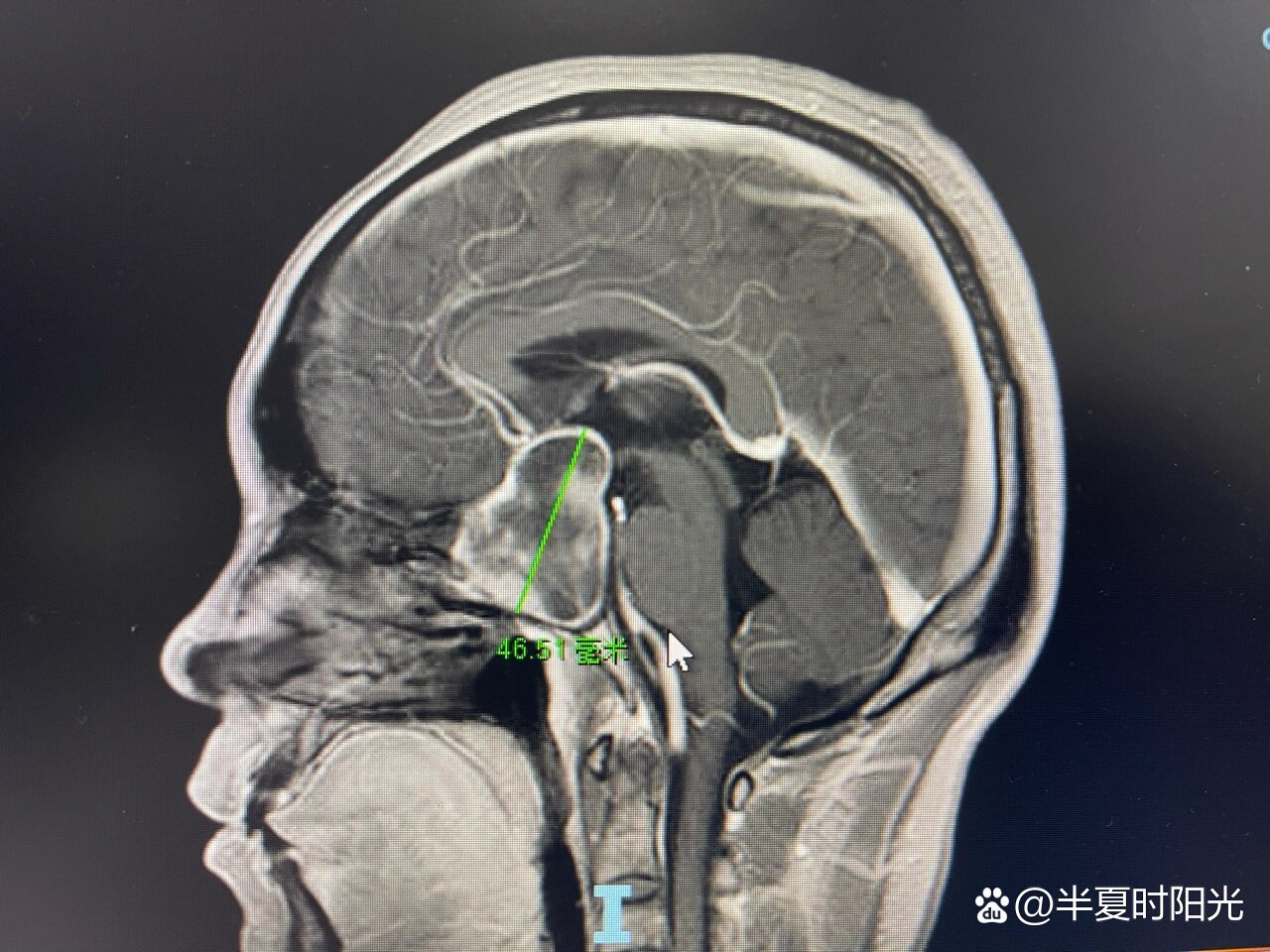 头痛视力下降警惕垂体瘤伴出血