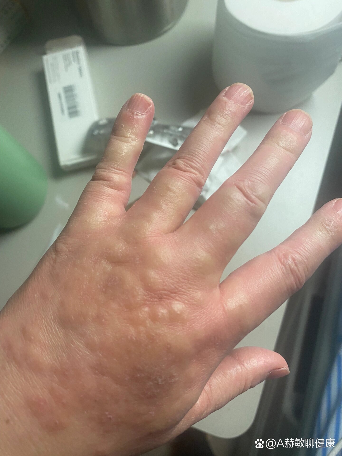 湿疹治愈的过程(10)-手部治疗篇