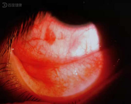 滤泡性结膜炎双眼发红,原因正是长期熬夜