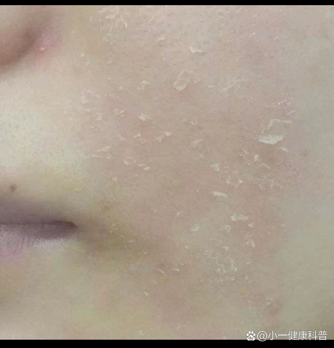 天冷了,脸部起皮姐妹们看过来