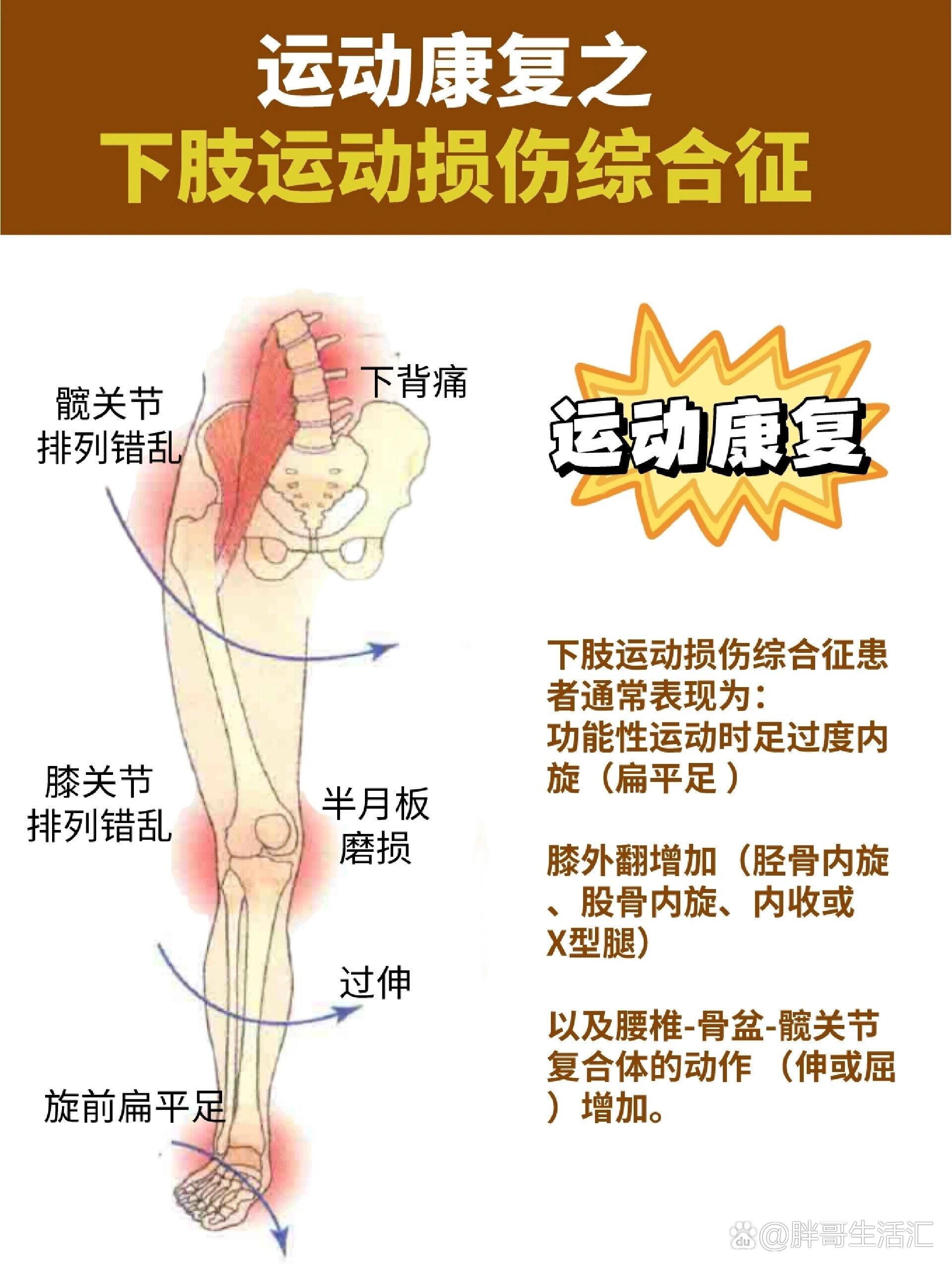  br>16615有可能过紧或过度活跃的肌肉包括腓骨肌群,腓肠肌外侧头