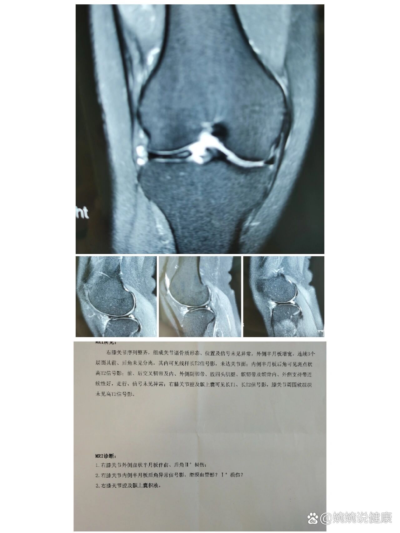 盘状半月板遗传几率图片