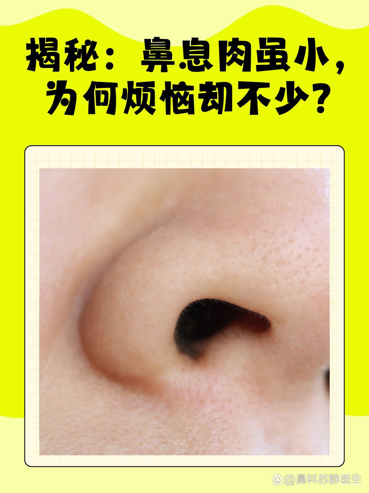 鼻息肉虽然小为何烦恼却不少?