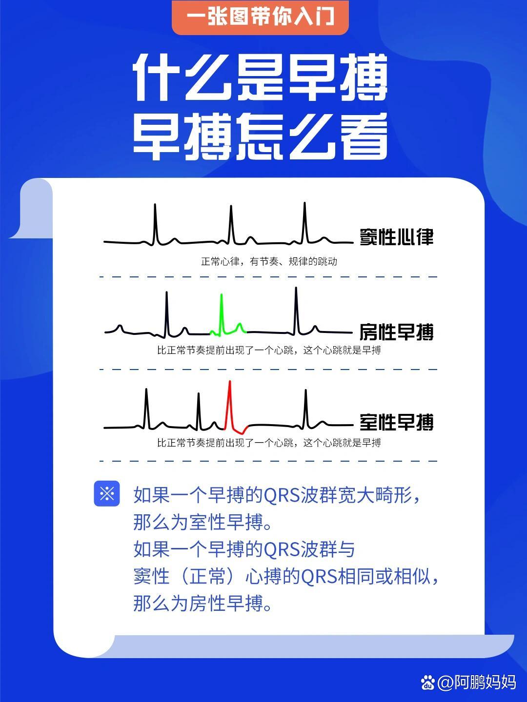 早搏的心电图表现图片