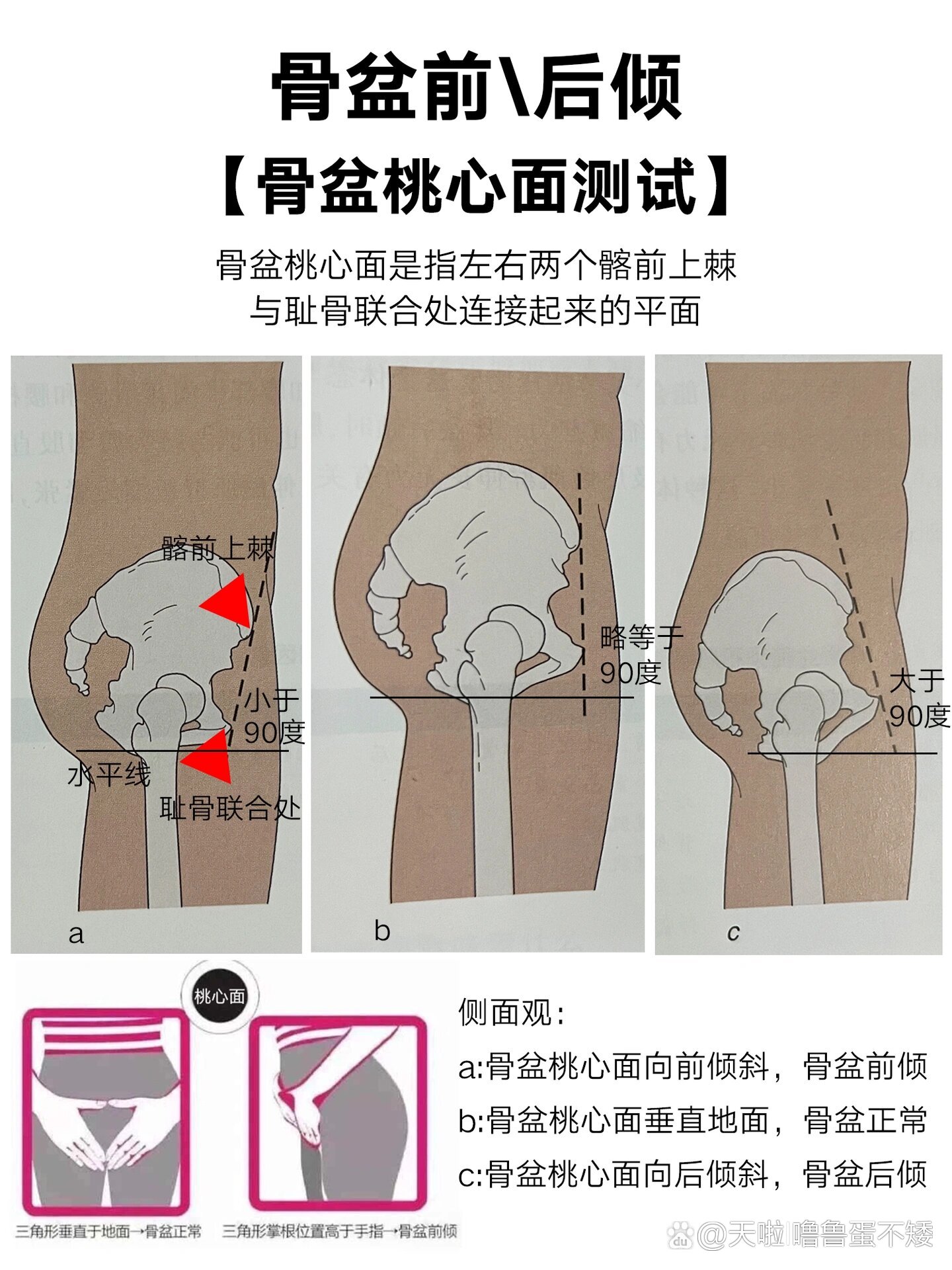 骨盆前倾角度图片