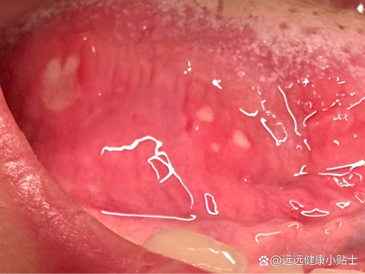 长在舌根的口腔溃疡