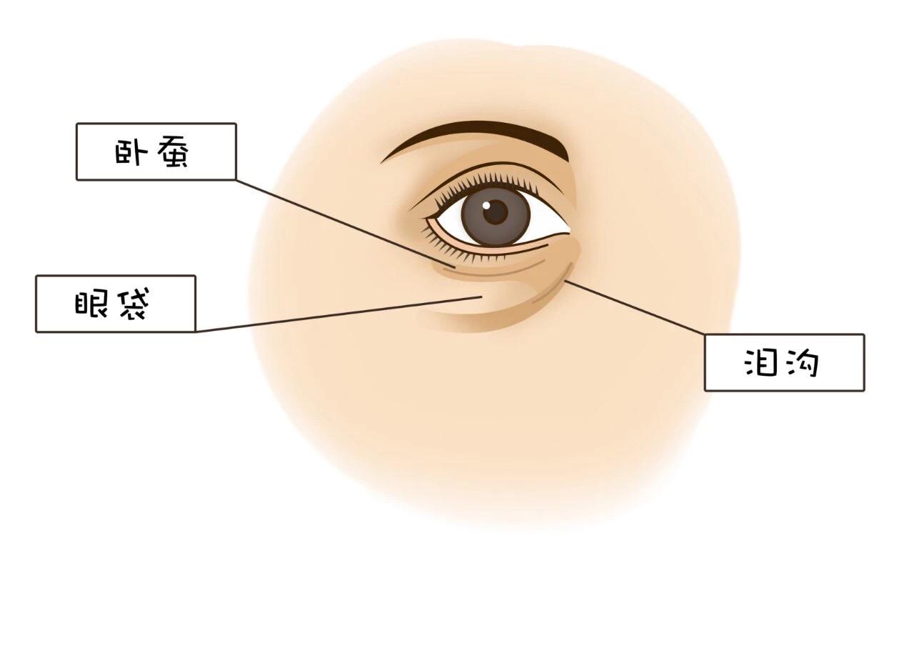 眼袋和泪沟都有?眶隔脂肪释放有用吗?