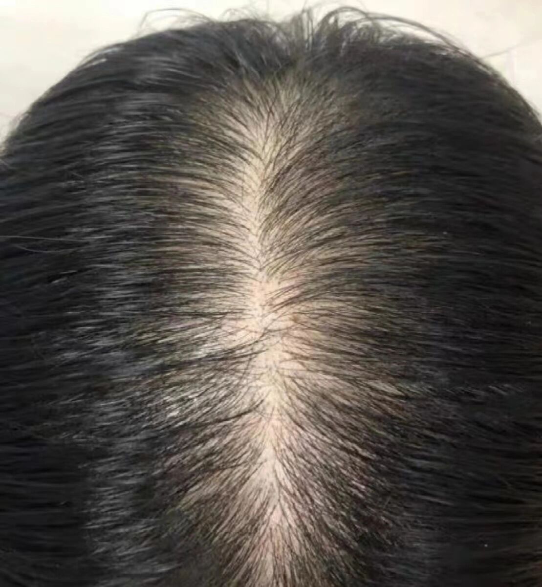 毛囊克隆治愈了我的遗传性秃顶