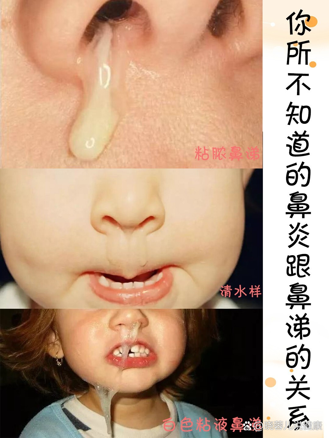🎈🎈鼻炎与鼻涕的关系你造么❓❓