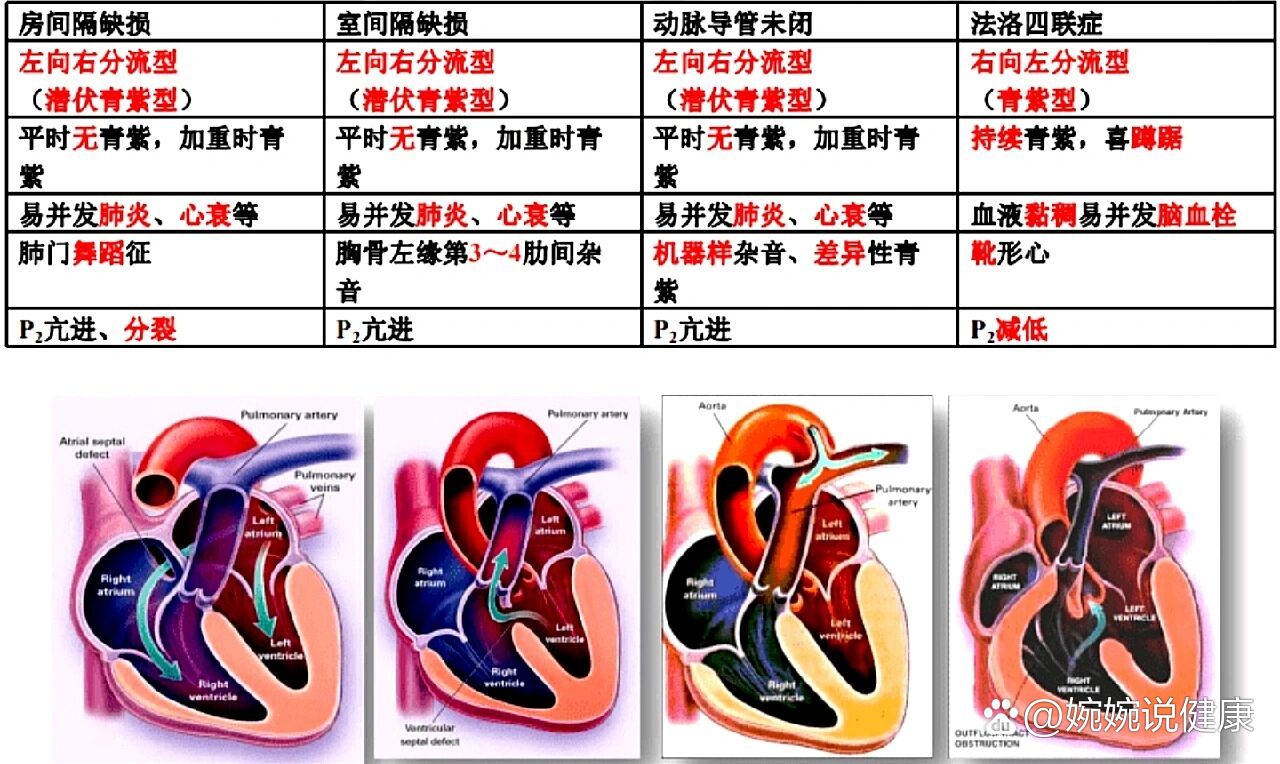 主动脉肺动脉间隔缺损图片