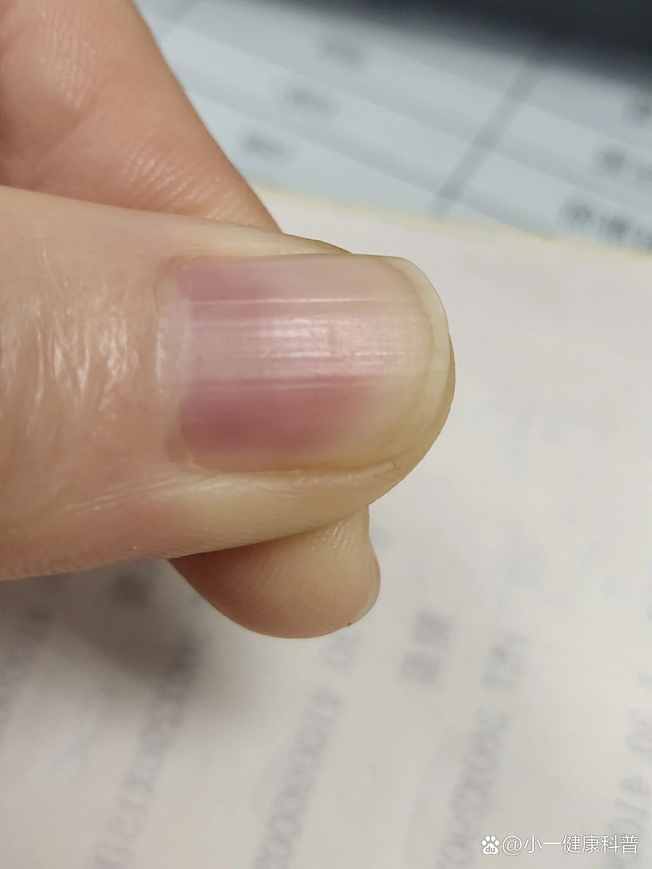 指甲有竖纹,啥情况啊?