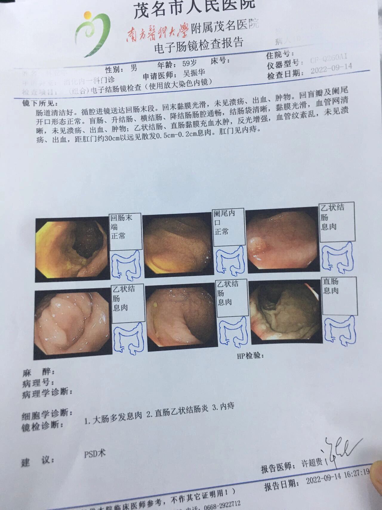 有做过大肠息肉微创手术的吗