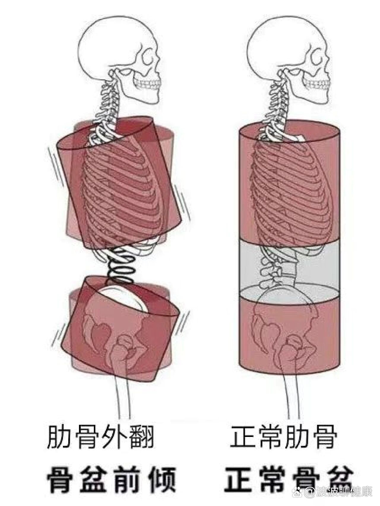 肋骨外翻图片 大人图片