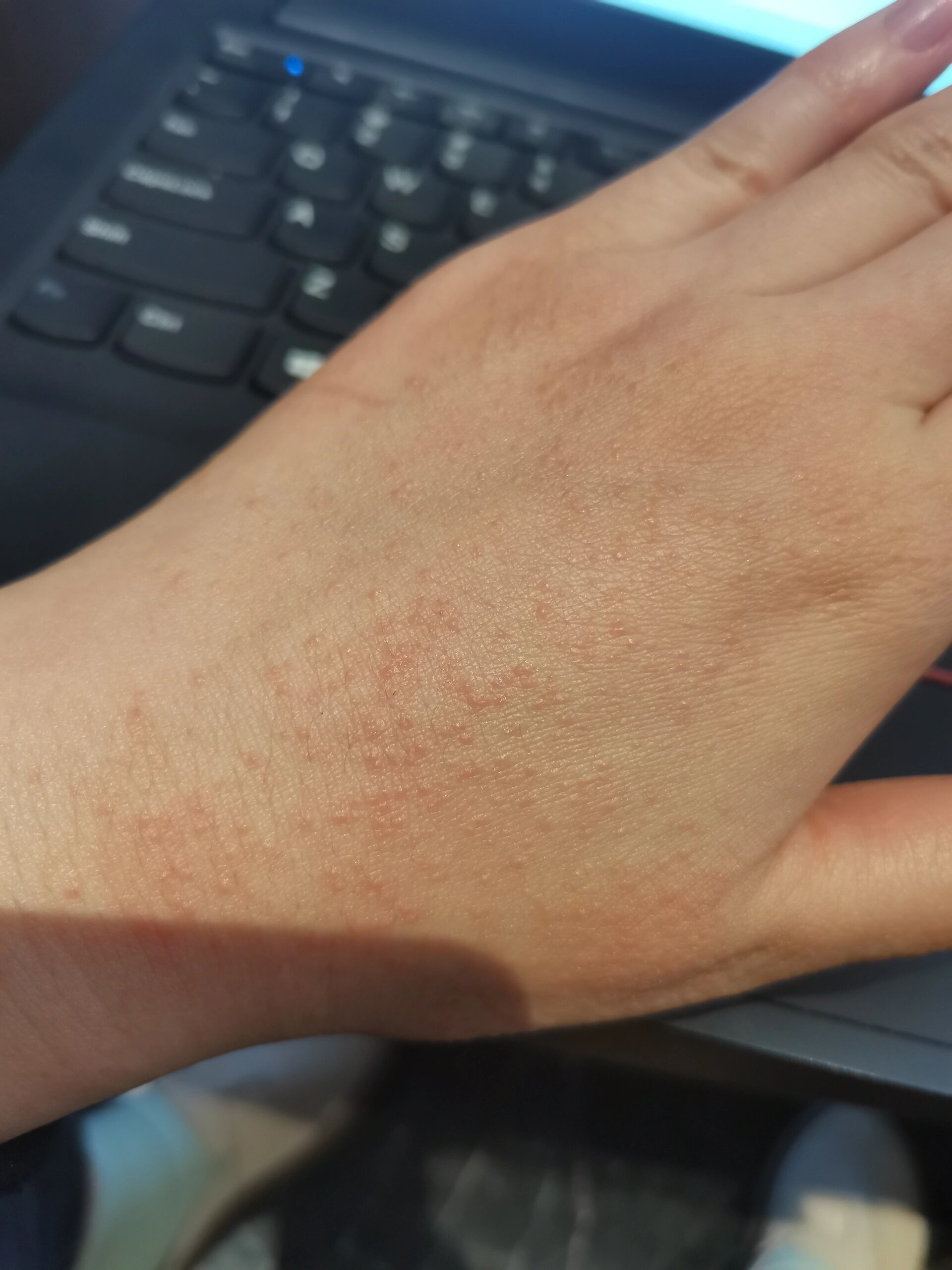 手背突然长了很多小疙瘩 还发红 这是什么疹子呀
