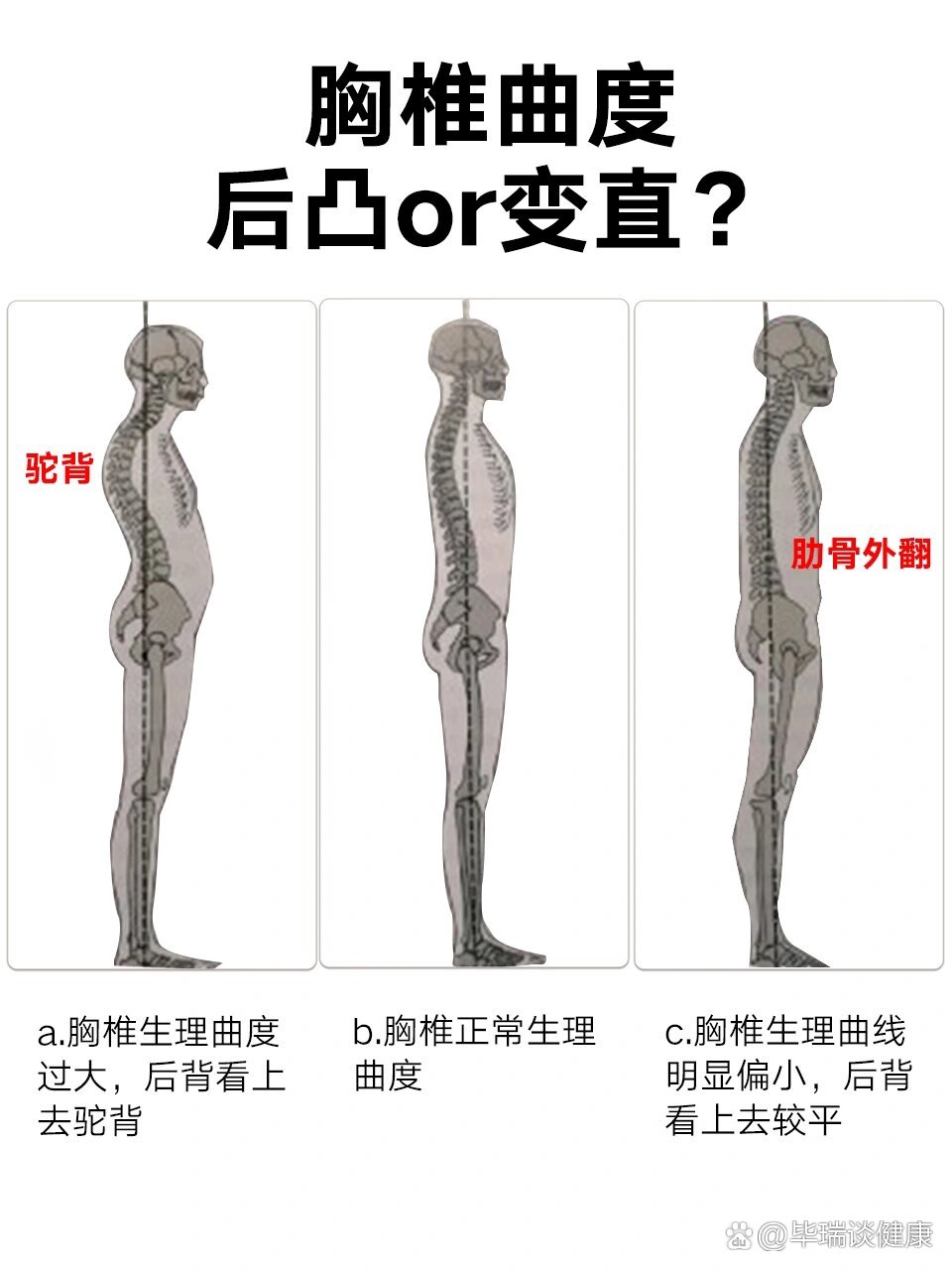 胸椎后凸正常范围图片