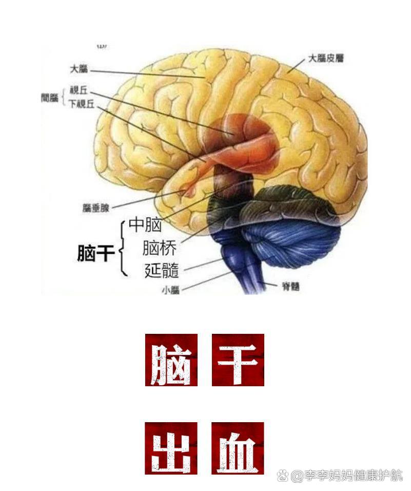 脑干出血是怎么引起的图片