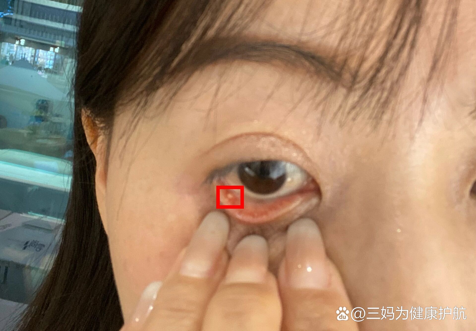  p>不痛也不痒的 br>眼睑里面长了一个白色的东西,不痛也不痒不知道对