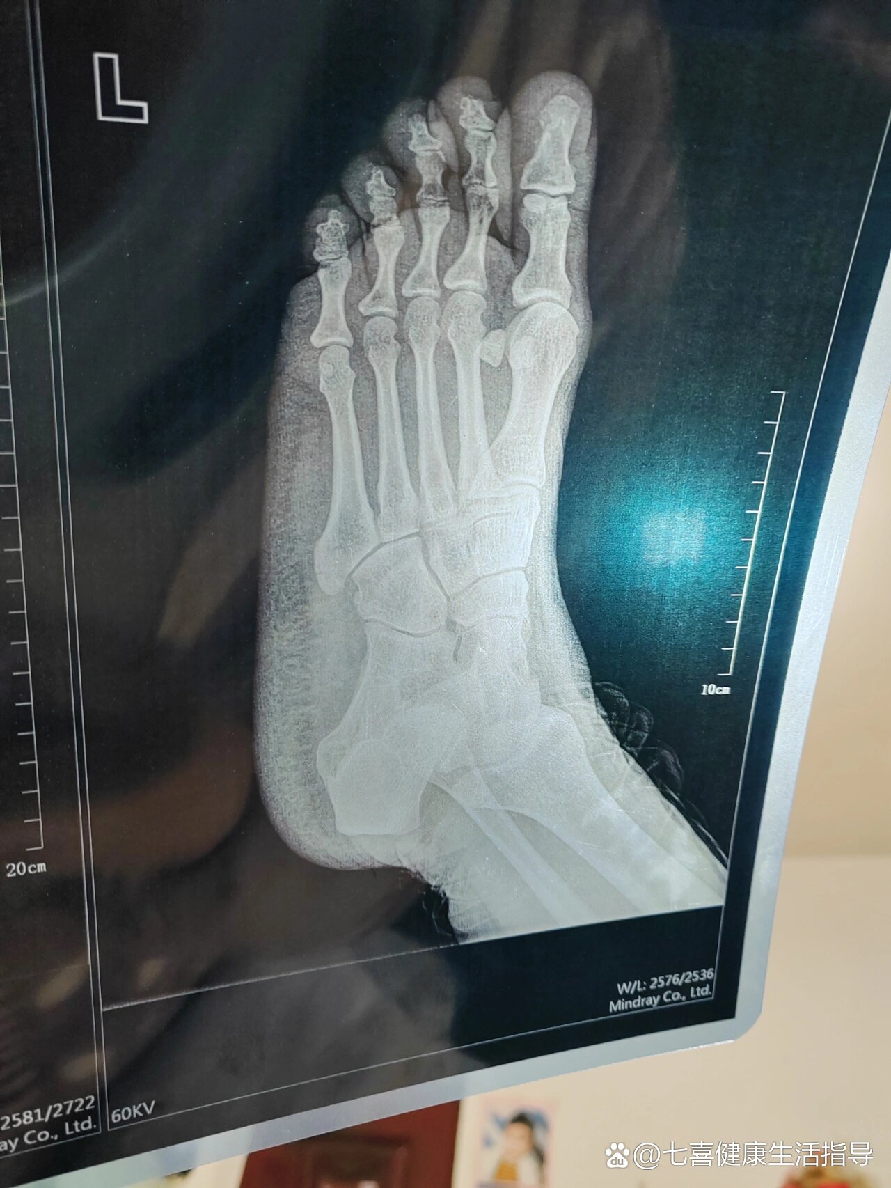 第五脚跖骨折一周就下地走路