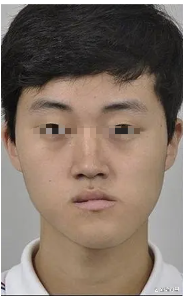 左右脸不对称嘴巴歪怎么矫正