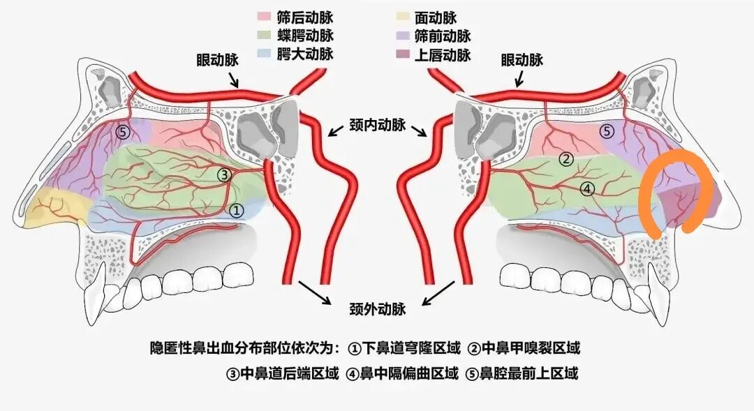 儿童鼻出血绝大部分是鼻腔前端粘膜糜烂引起,也就是我们常说的黎氏区