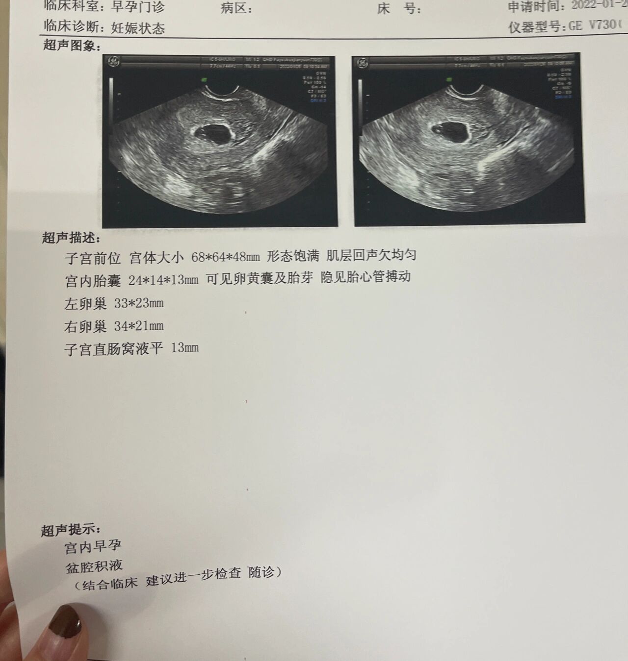 孕26周胎心位置图片图片