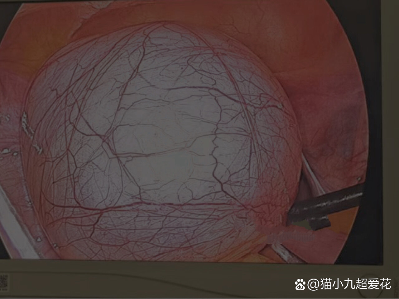 巨大的输卵管系膜囊肿