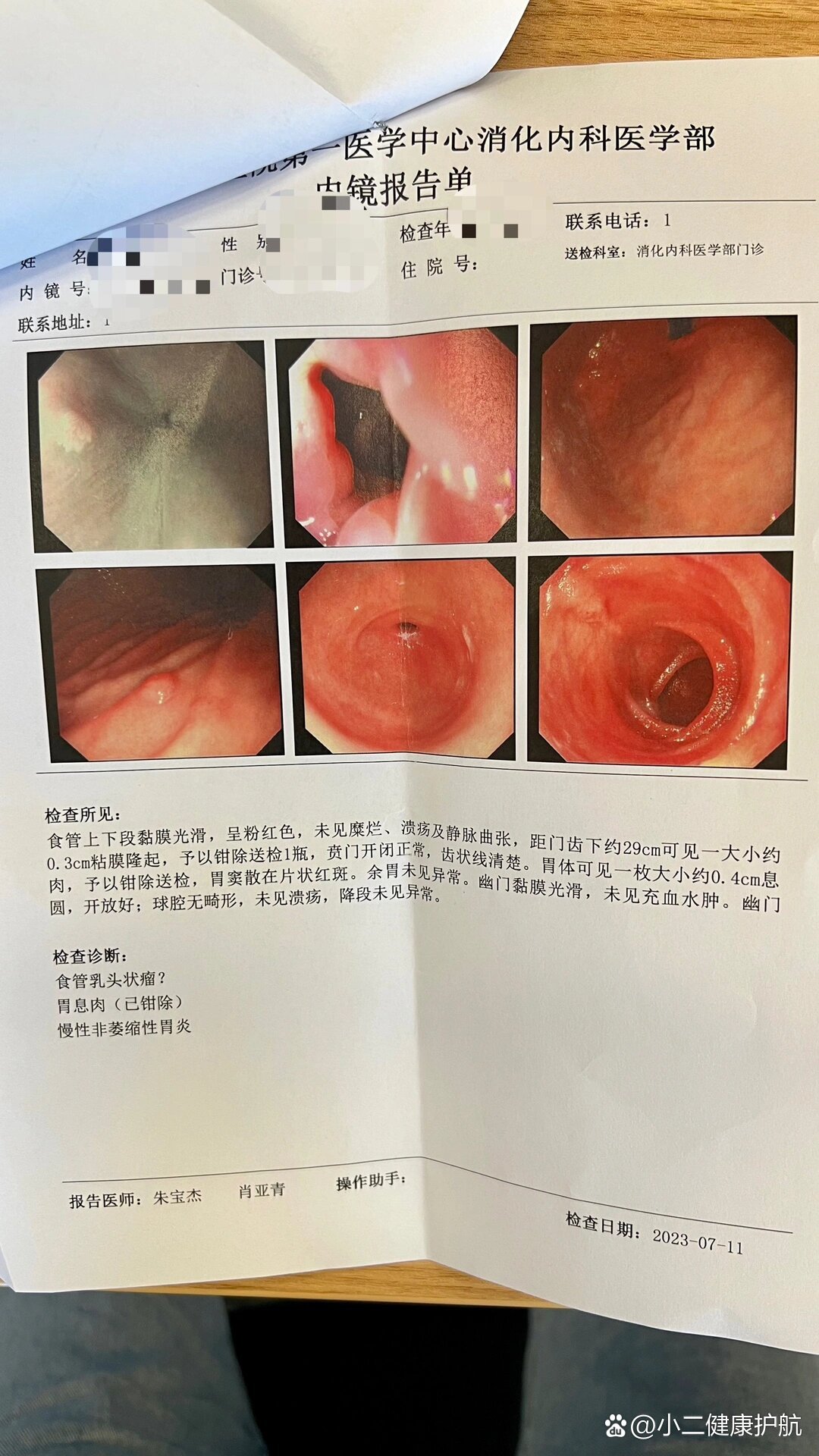 食管癌早期胃镜下图片图片