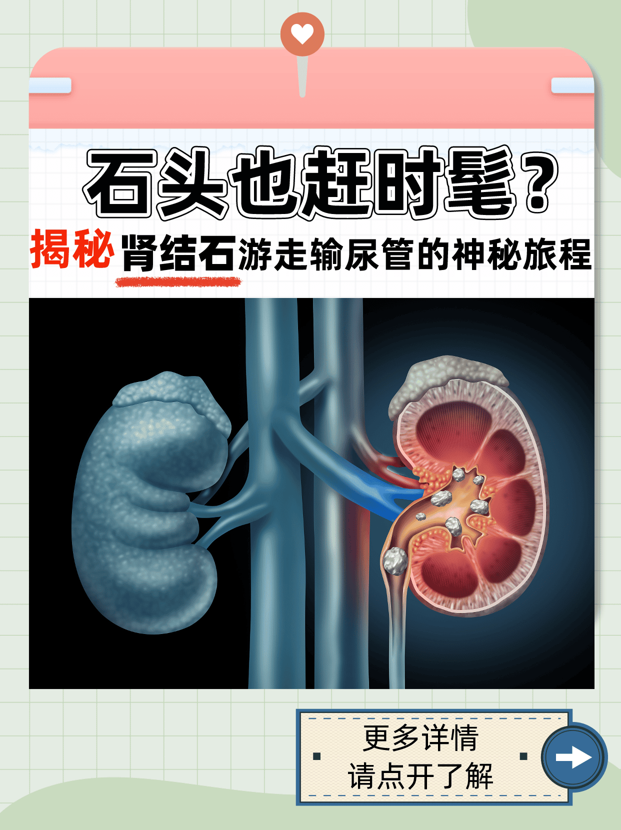 输尿管结石怎样排出图片