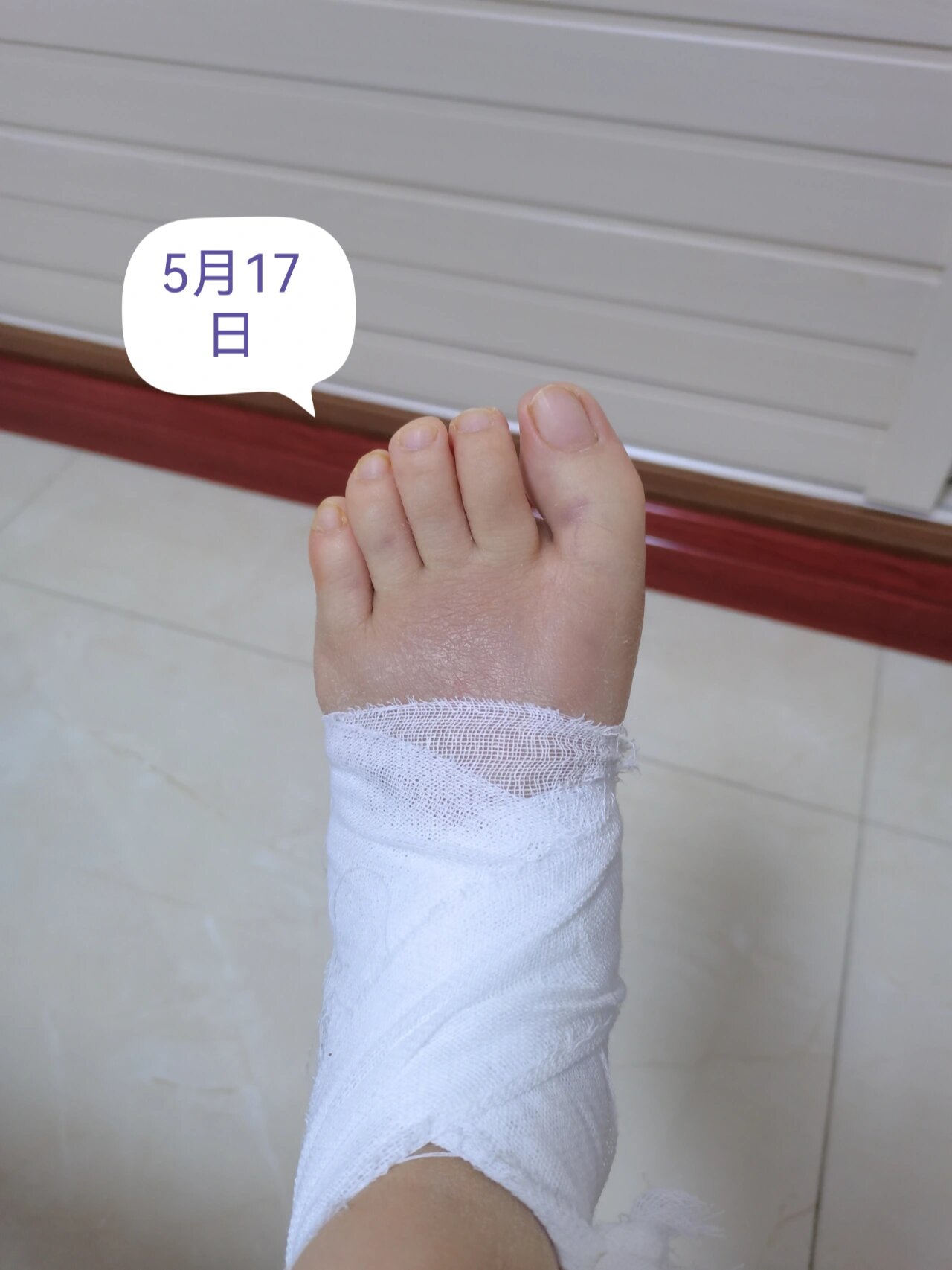 跖骨骨折第29天