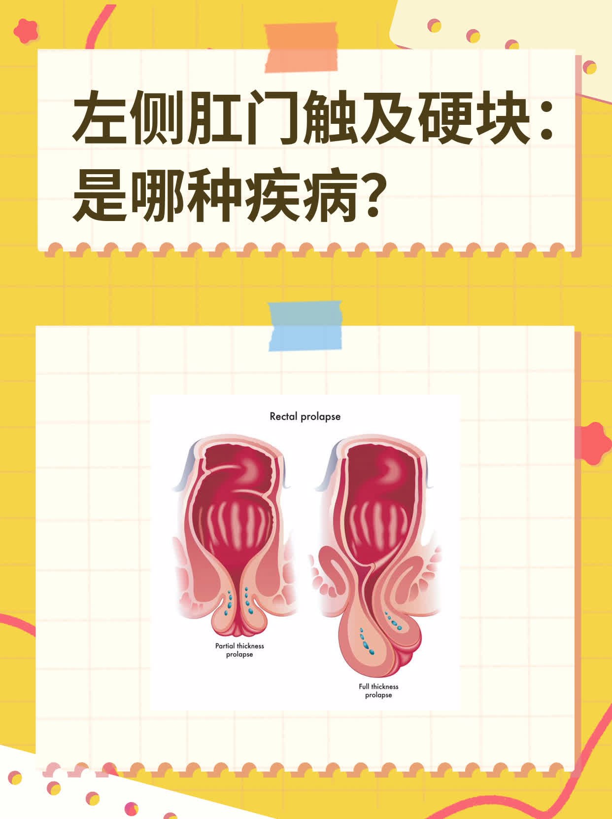左侧肛门触及硬块:是哪种疾病