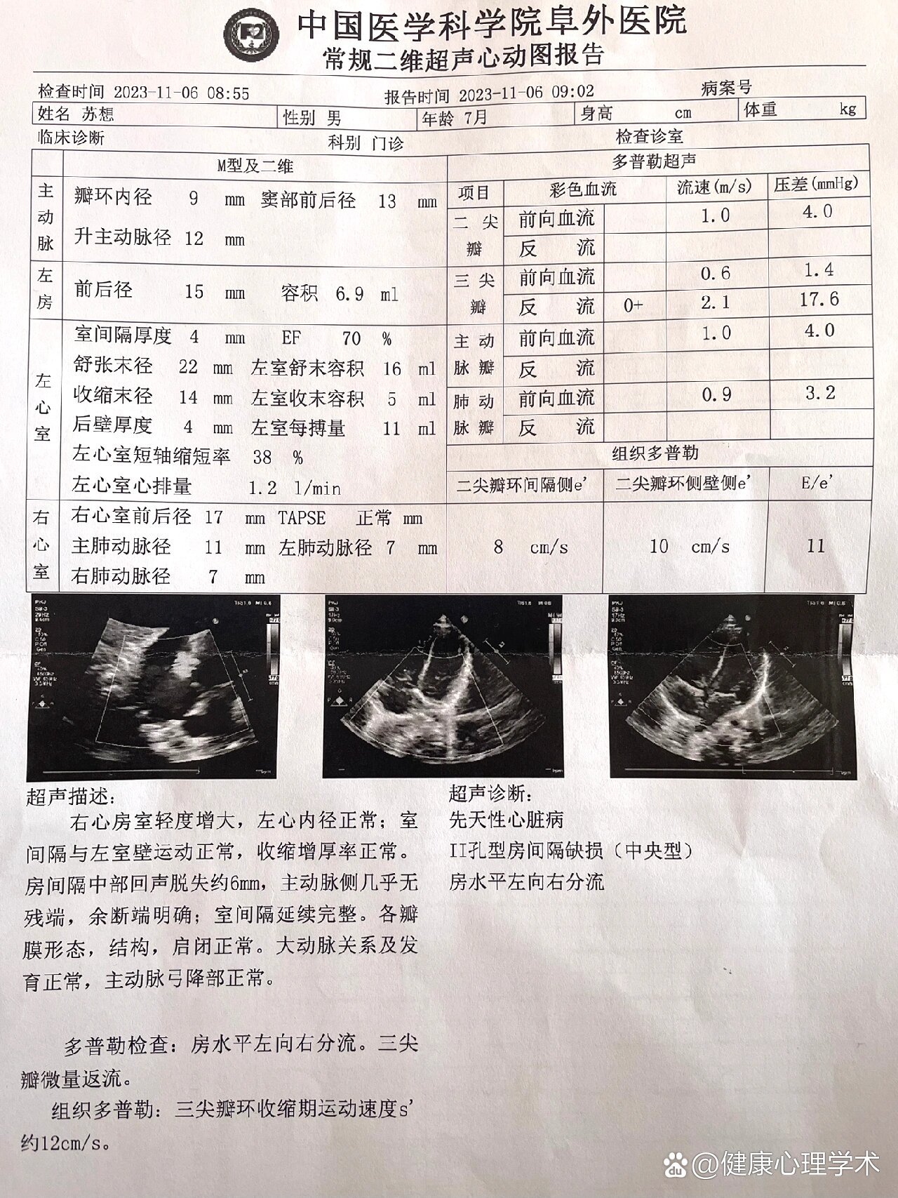 新生儿房间隔缺损图片