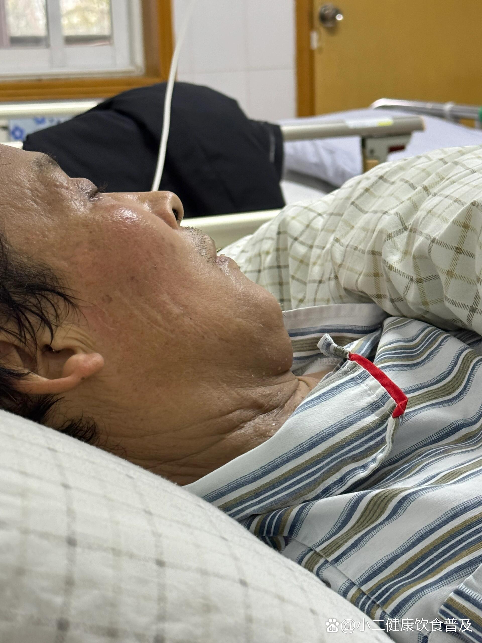 癌症之王-恶性黑色素瘤晚期