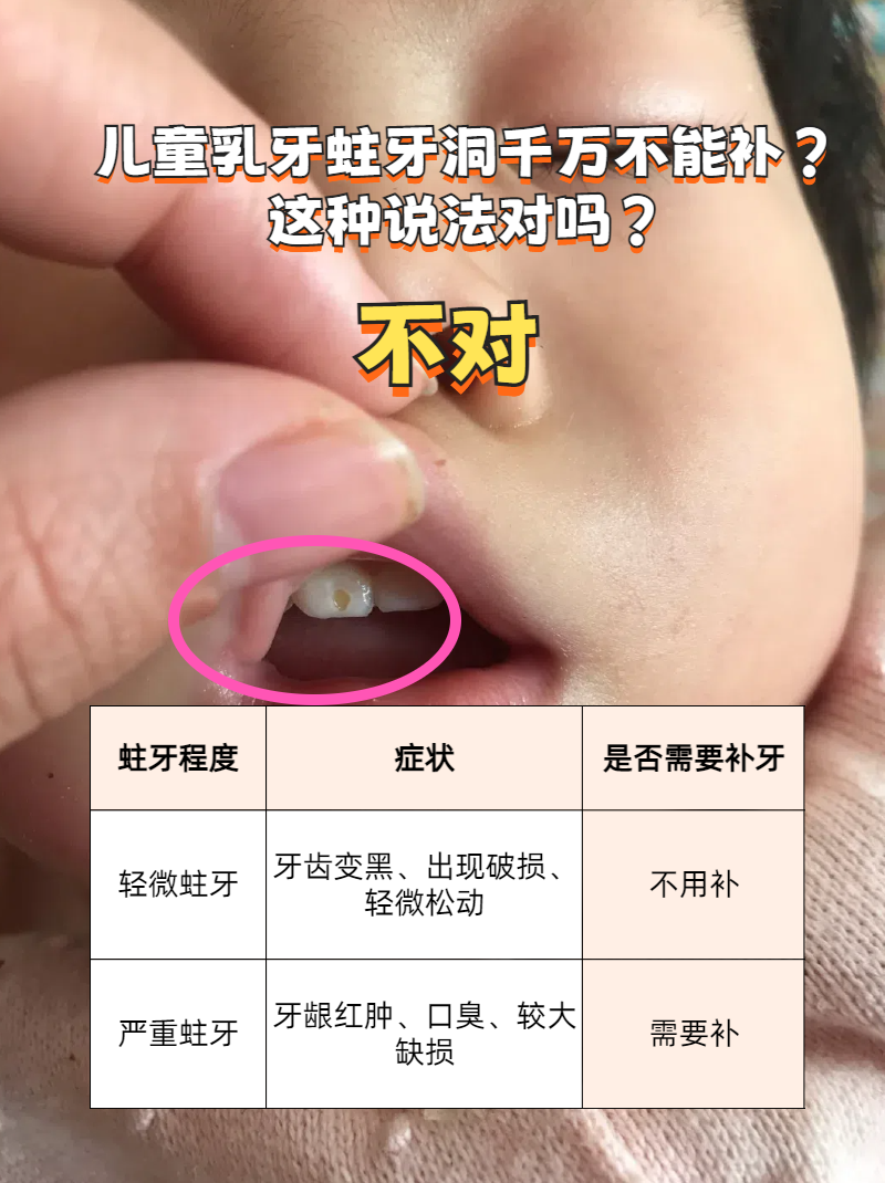 乳牙龋齿初期图片图片