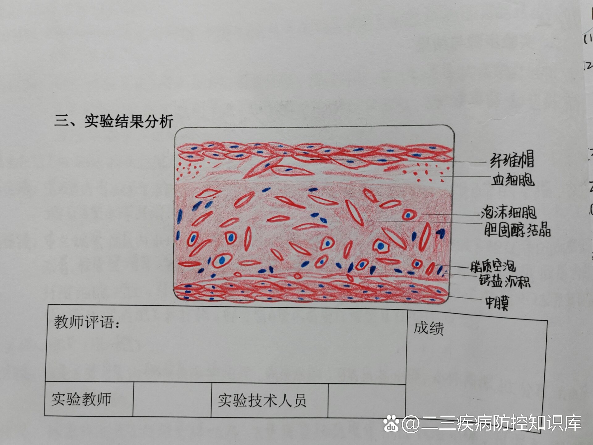 动脉粥样硬化切片图解图片