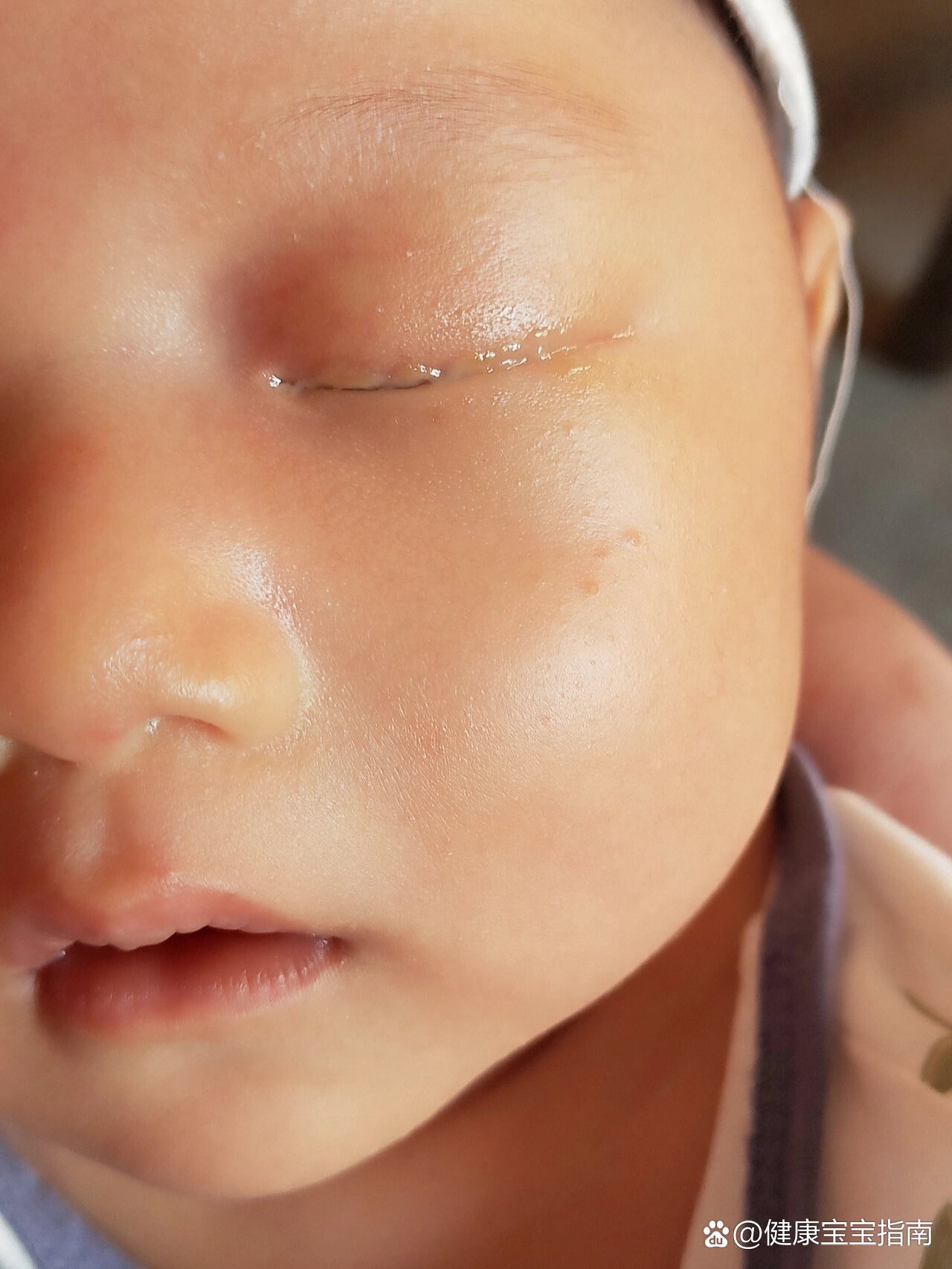 宝宝鼻泪管堵塞终于好了