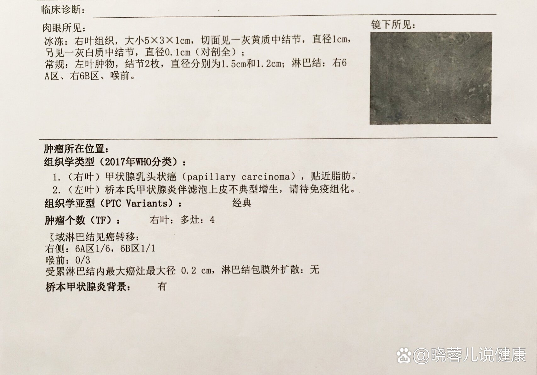 甲状腺半切手术病理报告