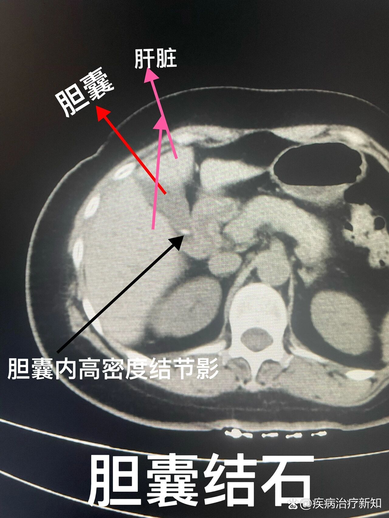 胆系结石(上腹部ct平扫)胆囊