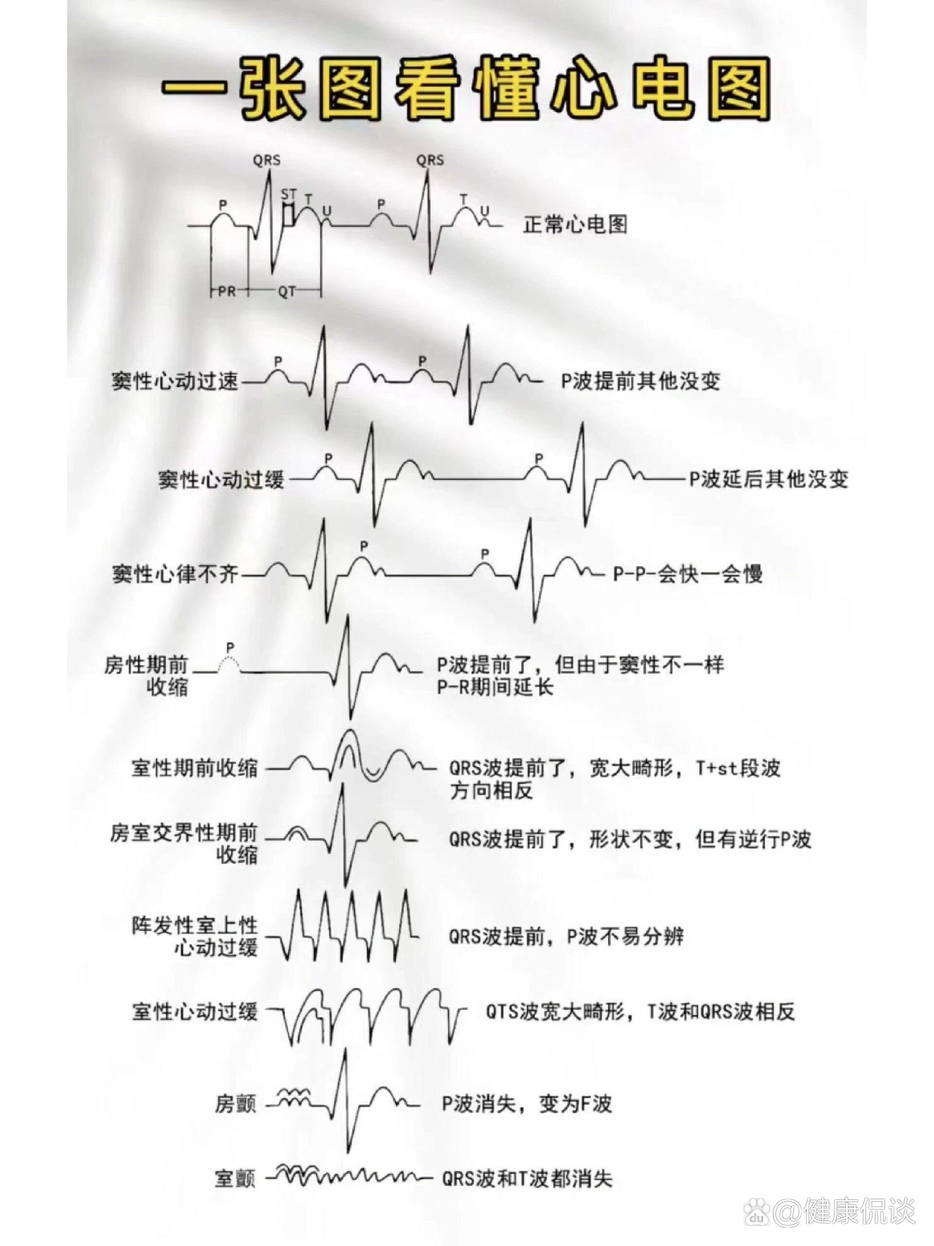 心室起搏心电图特点图片