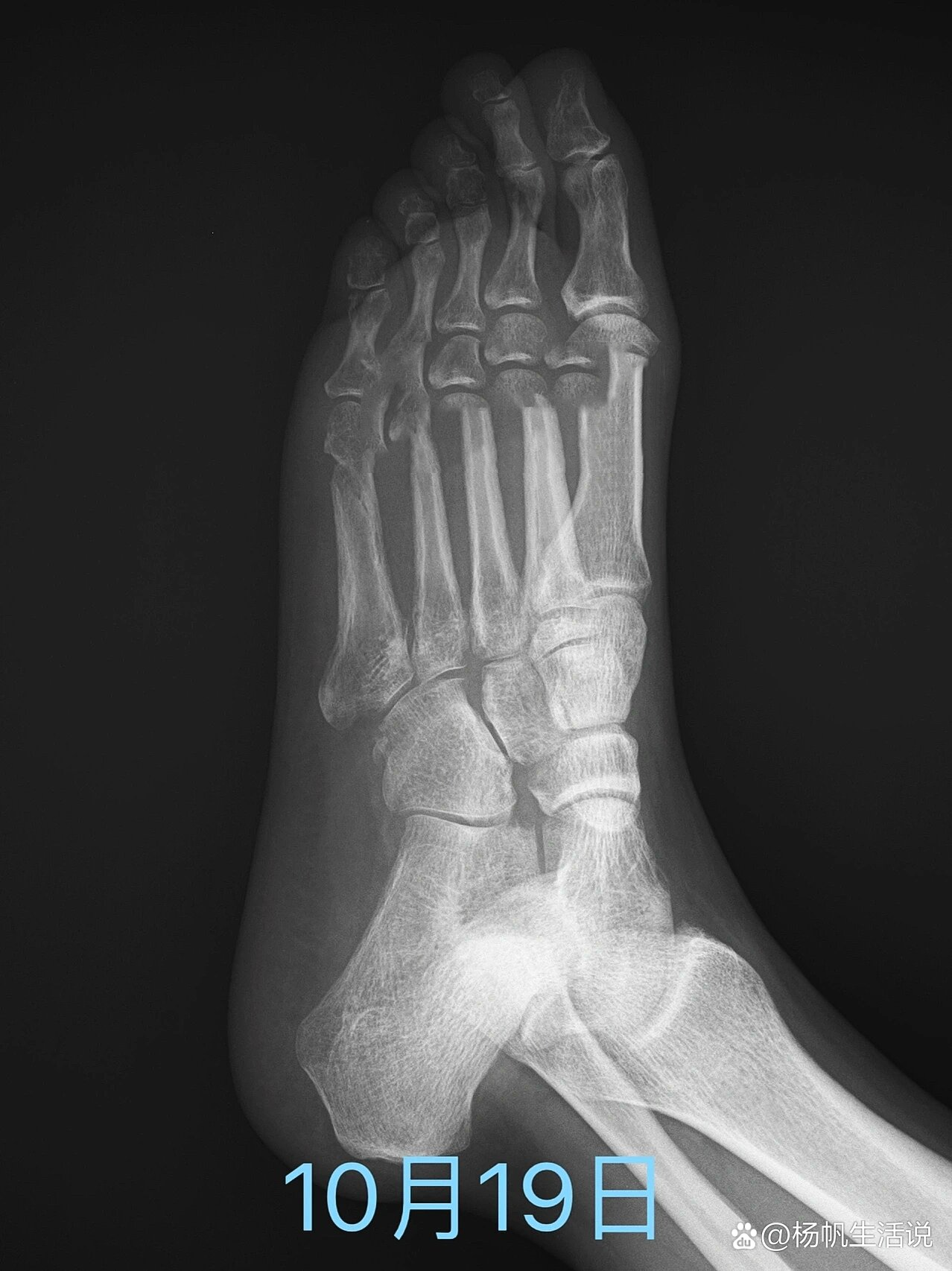第五跖骨骨折四个多月