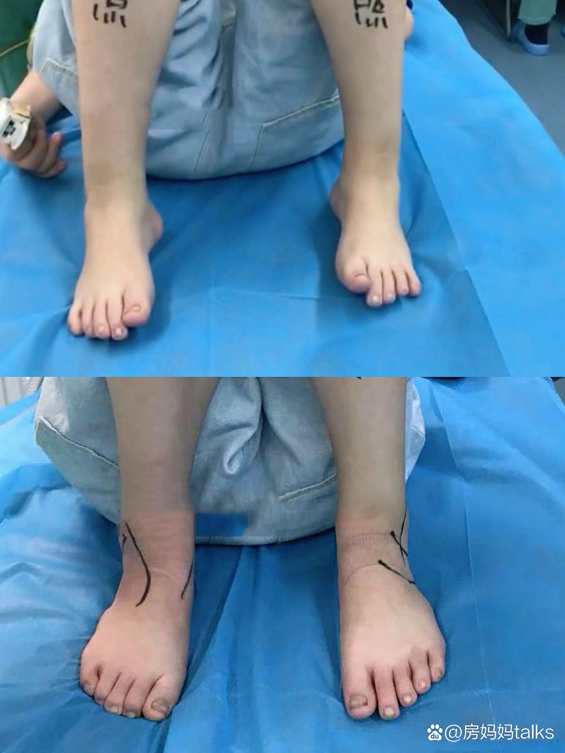 警惕|5岁小男孩内翻脚