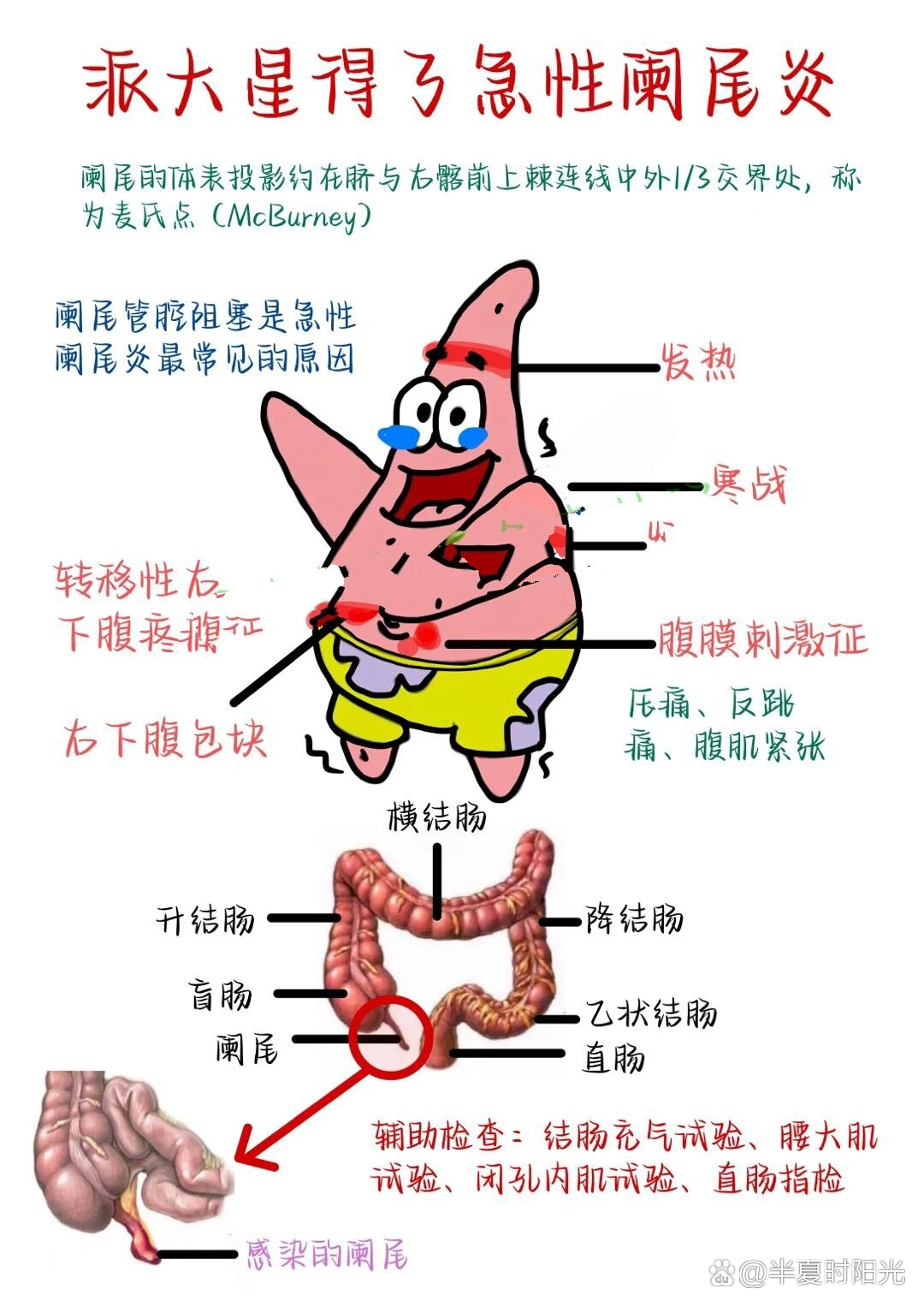 急性阑尾炎病理生理图图片