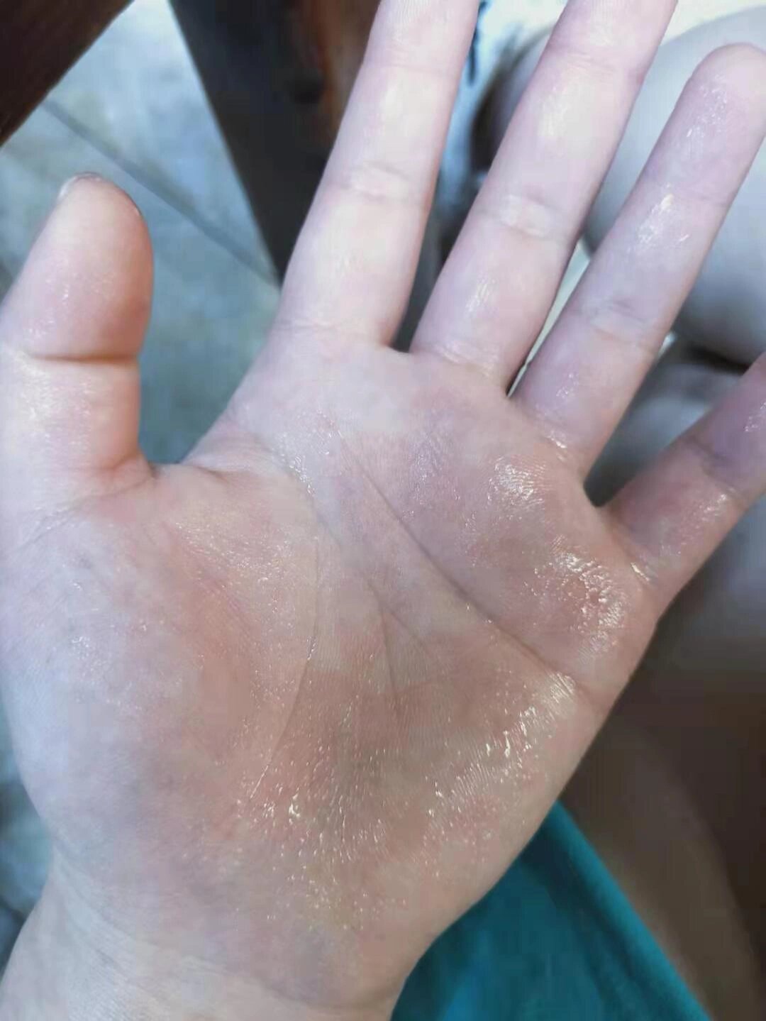 交感神经兴奋异常引起的手汗症有救了!