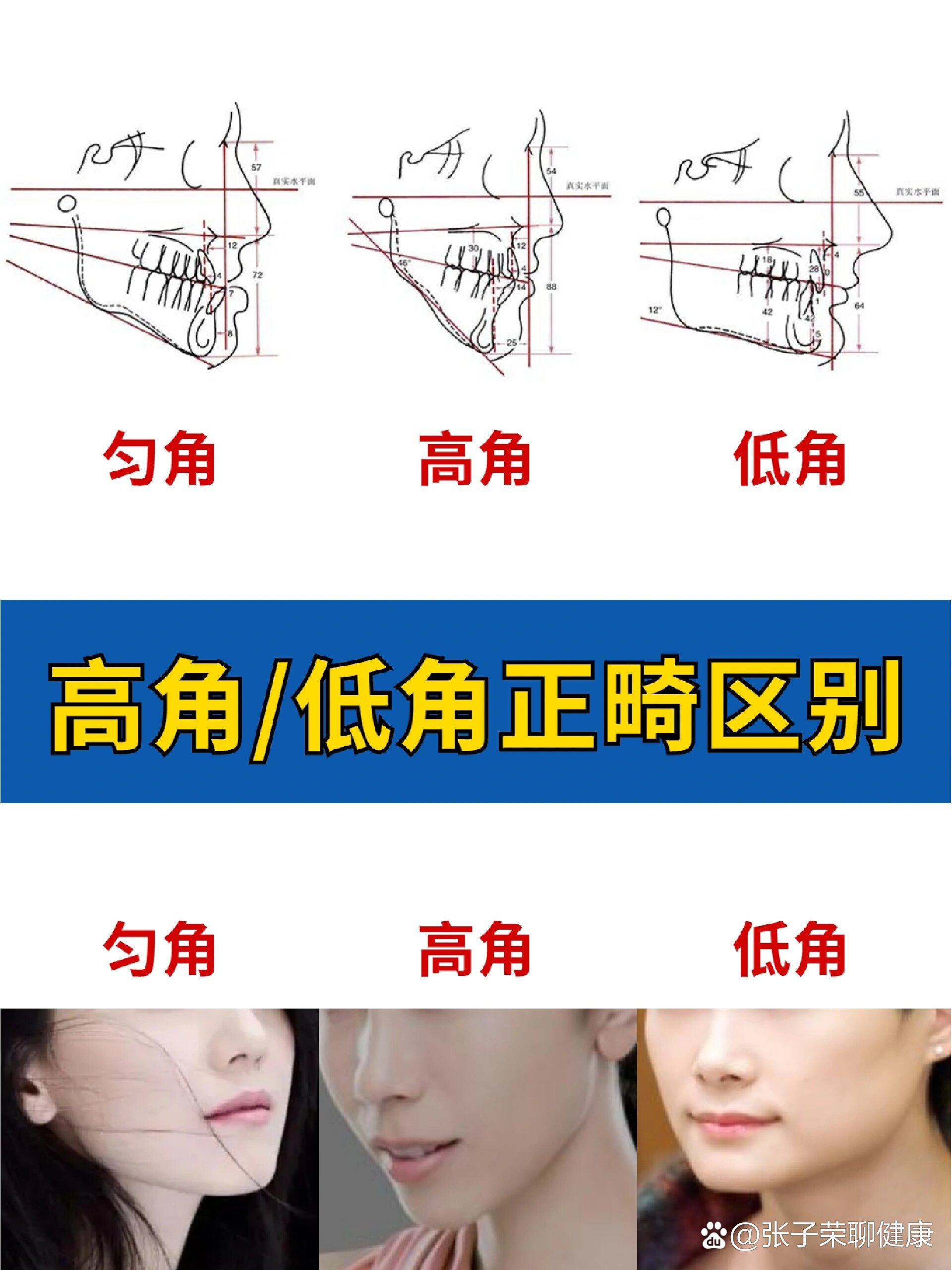 高角/低角判断方法和正畸区别✅