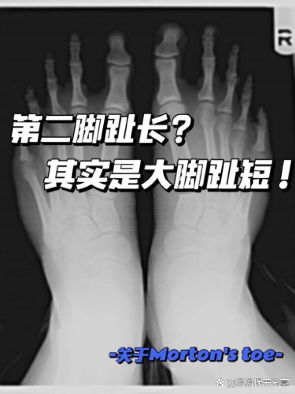 为什么第二脚趾特别长?