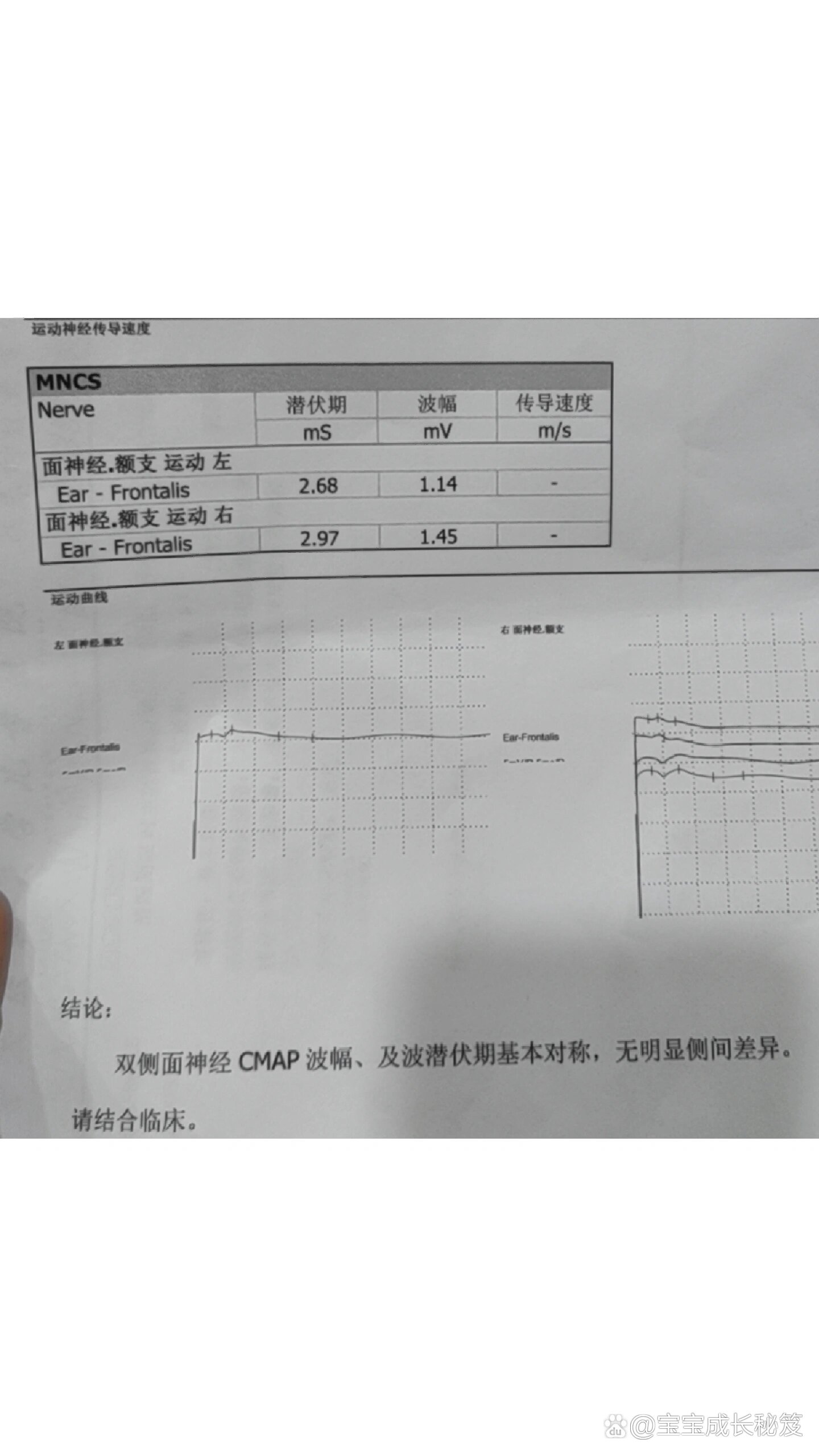 歪嘴哭综合征